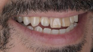 Before - Sahil Patel