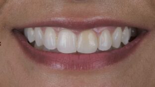 Before - Sahil Patel
