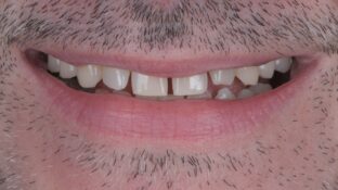 Before - Sahil Patel